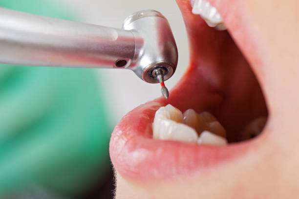 Best Emergency Wisdom Tooth Extraction in , ND